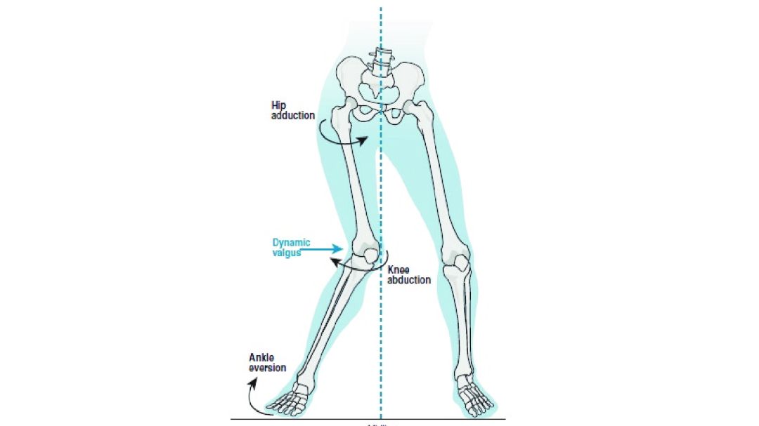 腿粗还不直小腿还外翻,怎么走路小腿才不会粗