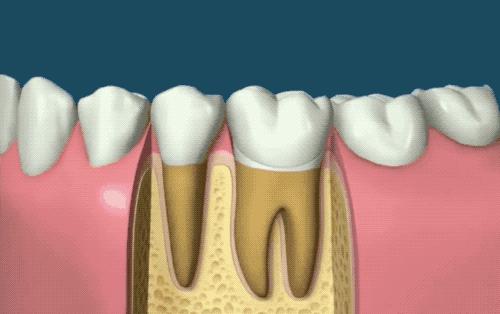 根管治疗没那么可怕,根管治疗有什么意义吗