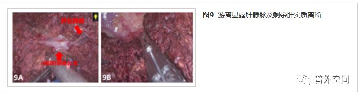 吲哚菁绿荧光引导腹腔镜解剖性肝脏Ⅶ段切除手术流程