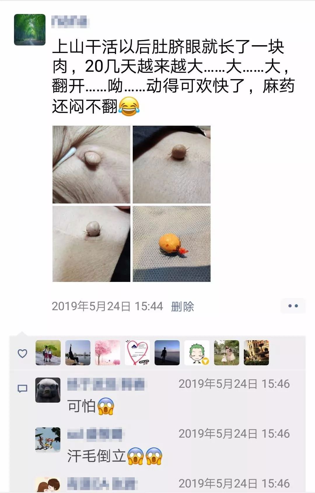 成人肚脐眼凸起肉球,肚脐眼隆起的肉球