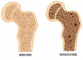 天天补钙对身体有什么好处,骨质疏松如何有效的补钙