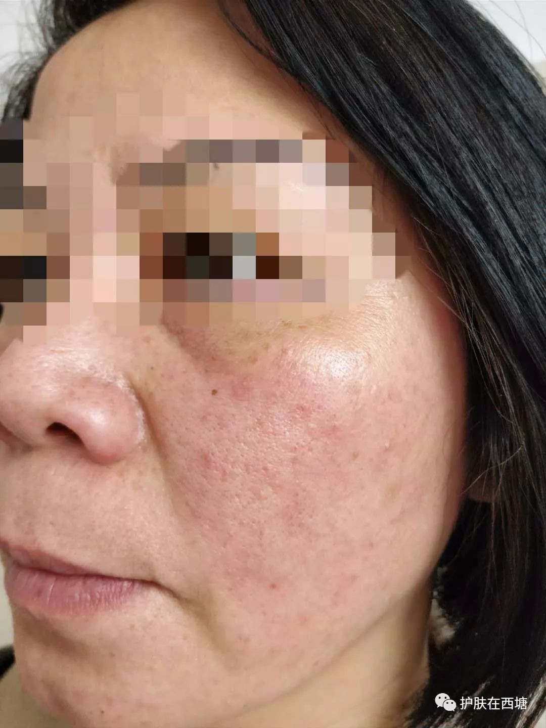 关于皮肤皮炎的几种症状,面部皮炎中医诊断名称