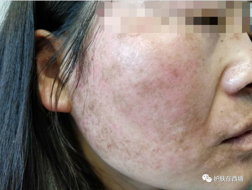 激素依赖性皮炎反复出疹子怎么办,激素依赖性皮炎好了以后怎么护肤