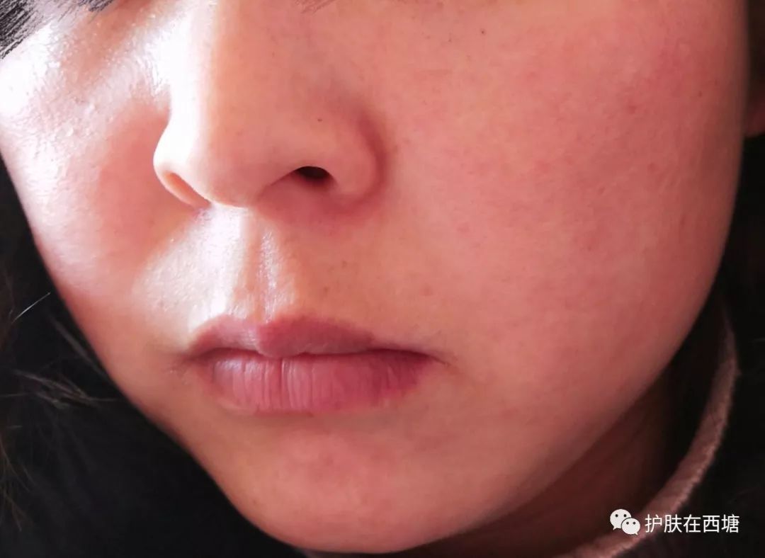 激素依赖性皮炎反复出疹子怎么办,激素依赖性皮炎好了以后怎么护肤