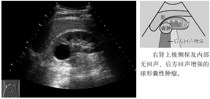 肾盏憩室和肾囊肿b超表现,肾盏憩室误诊肾囊肿案例