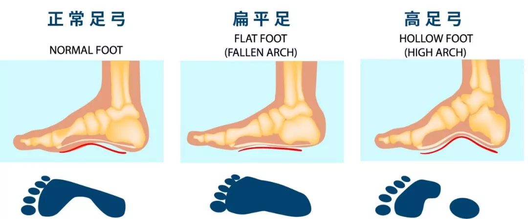 鞋前跟磨脚解决神器,新鞋子磨脚真难受实用窍门变舒服