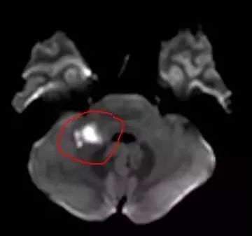 危险27岁女子突发脑梗,一女子突发脑梗