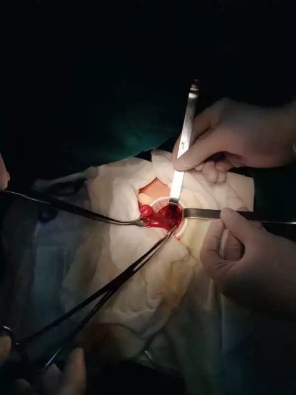 心疼！出生2天早产儿腹胀如包子生命垂危，医生打开腹部一看吓坏了