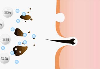 痘痘闭口里面有油脂,鼻子上的痘痘是青春痘还是粉刺