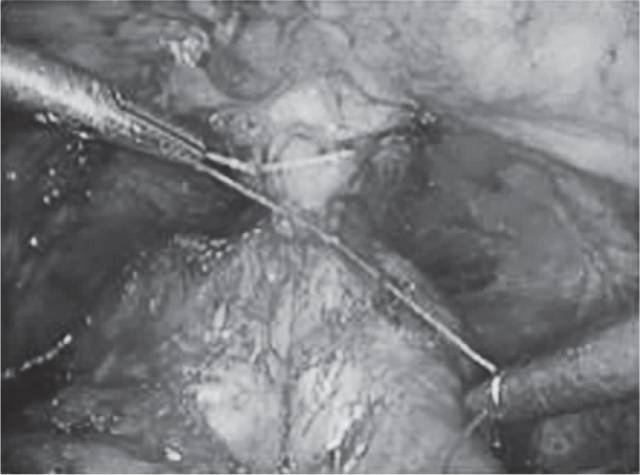 前列腺癌手术根治需切除睾丸吗,前列腺癌是切除还是保守治疗