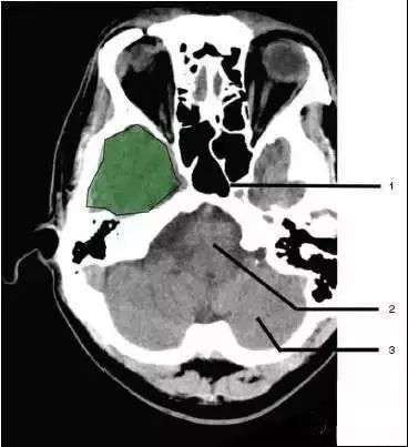 颅脑影像读片教程,颅脑影像读片怎么看