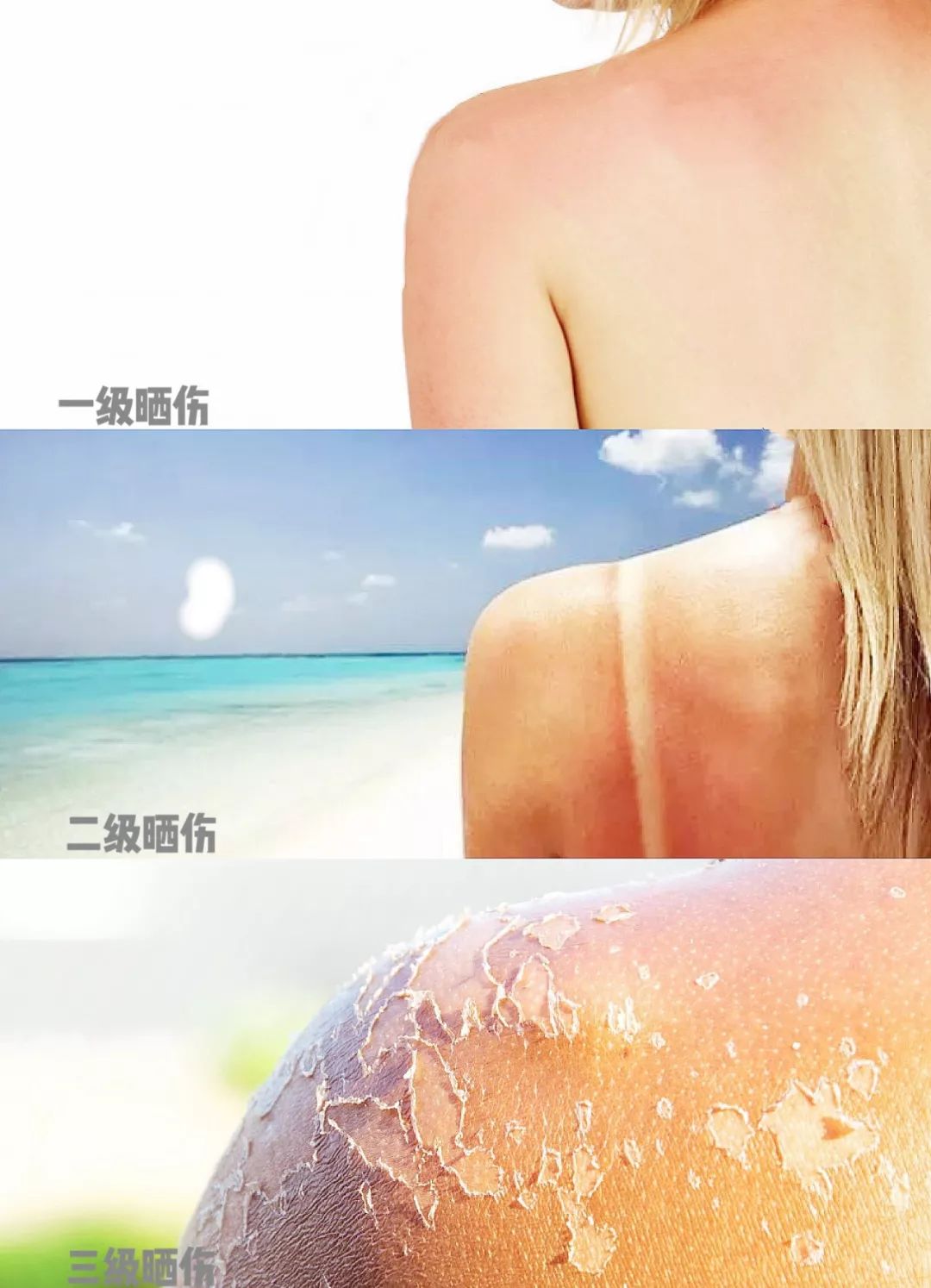 晒后修复对皮肤有伤害吗,太阳晒后皮肤发红发痒怎么修复