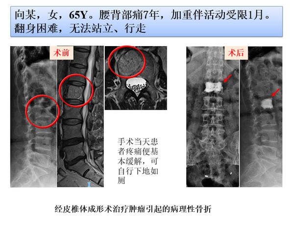 「筋骨堂」脊柱肿瘤可精准诊断，治疗选择大小皆宜