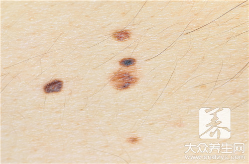 腋下长瘊子什么寓意,腋下长瘊子好不好