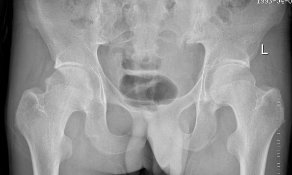 骨道堂治疗强直性脊柱炎效果,御医堂治疗强直性脊柱炎