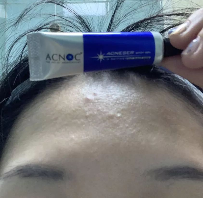 断货王祛痘胶囊,秒杀祛痘化妆品一元