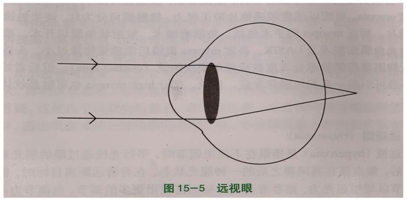 眼科医生检查后，说孩子眼睛“屈光不正”，是什么意思？