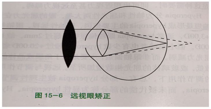 眼科医生检查后，说孩子眼睛“屈光不正”，是什么意思？