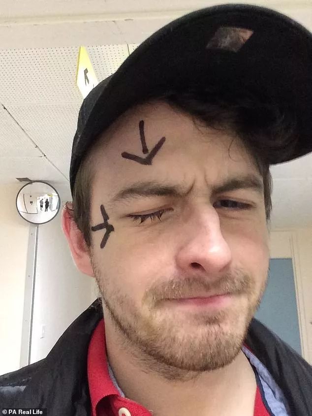 戴隐形眼镜导致角膜内皮细胞减少,因为戴隐形眼镜眼睛肿了