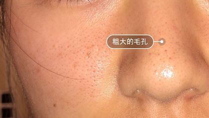 拒绝草莓鼻夹子夹出粉刺,拒绝草莓鼻毛孔粗大