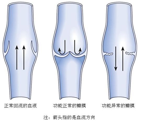 筋疙瘩怎么去除,筋疙瘩好治吗