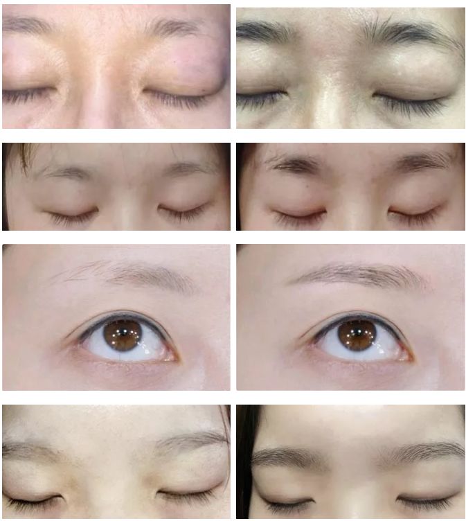 纹眉一周后眉毛还没完全掉痂,纹眉之后我的眉毛不长了