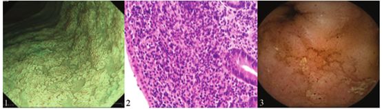 腹痛腹泻水样便恶心怎么回事,腹痛腹泻水样