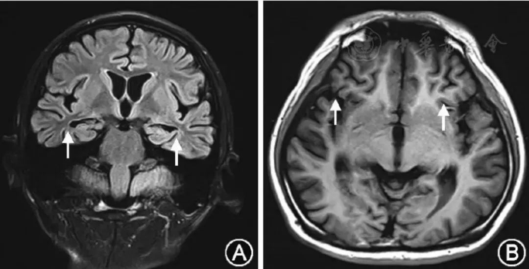 MMA伴cblC型并发ICH、巨细胞病毒脑室脑炎、霉曲菌感染丨3分钟读片·第6期