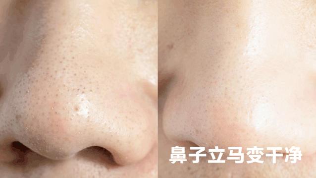 用黑头仪吸完黑头黑头还会再长吗,黑头别膨胀3招把你刷光光