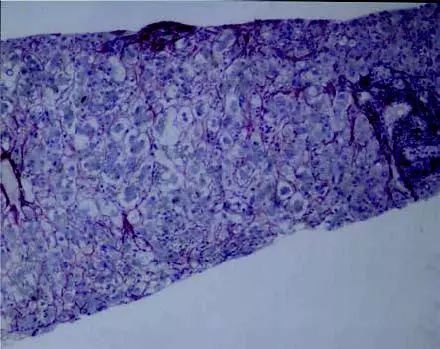 妊娠期急性脂肪肝是什么引起的,妊娠期急性脂肪肝怎么治疗