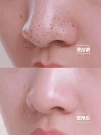 鸡蛋清除黑头,快速物理去黑头