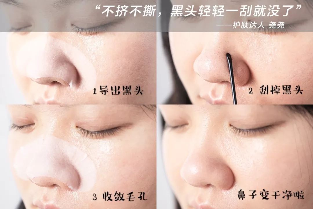 严重的黑头怎么处理教程,反复黑头的原因和解决方法