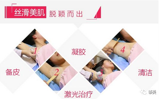 成都医美月▏现在不脱毛，夏季猕猴桃，你不脱毛？100%尴尬