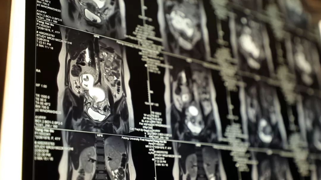 生命缘33周产妇胎死腹中,生命缘42岁高龄产妇完整版