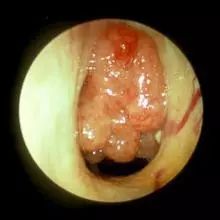 腺样体肥大手术家长反馈,家长腺样体肥大