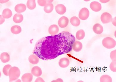 外周血细胞形态分析能查出什么病,外周血细胞形态能看出白血病吗