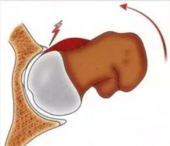 股骨头坏死保髋手术能撑几年,股骨头坏死的保髋治疗