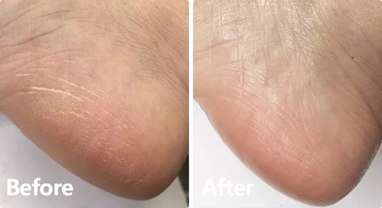 专为脚臭人士准备的抑菌防臭袜,多功能袜改善各种脚臭