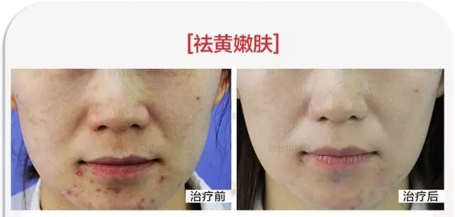 ‘斑’弄是非，超皮秒要你好看