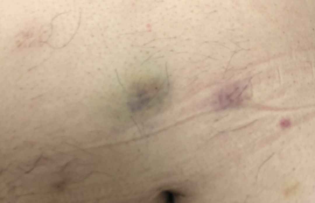 护士基护重点,保胎打低分子肝素一天打几针