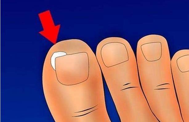 脚指甲增厚长进肉里最佳治疗方法,指甲根部嵌甲太深拔不出来怎么办