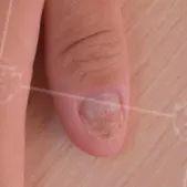 灰指甲致癌吗,灰指甲美甲的禁忌