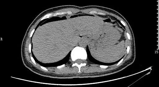 急诊科常见急腹症观察,腹部急诊影像大全值得收藏