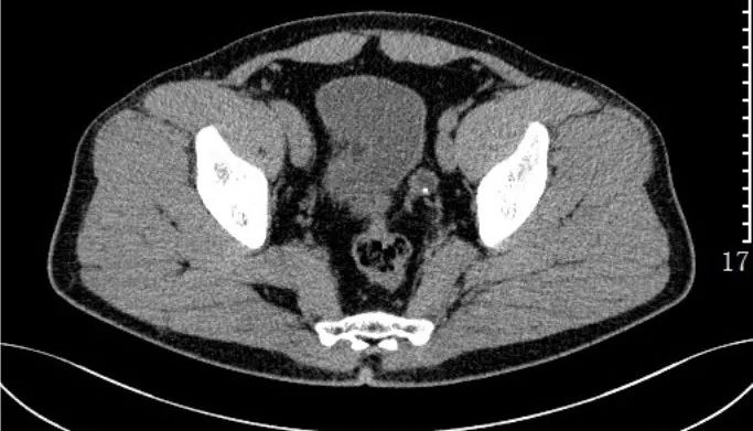 急诊科常见急腹症观察,腹部急诊影像大全值得收藏