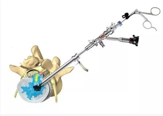 老年人腰椎间盘突出吃什么药止痛,老年人腰椎间盘突出压迫神经腿疼