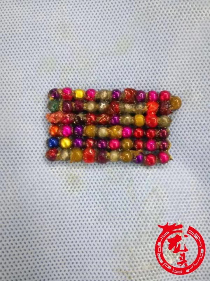 6岁男孩误食巴克球,11岁误食三颗巴克球怎么办