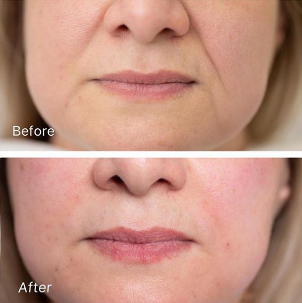 法令纹眼纹一个都逃不掉,法令纹和眼纹怎么才能有效改善