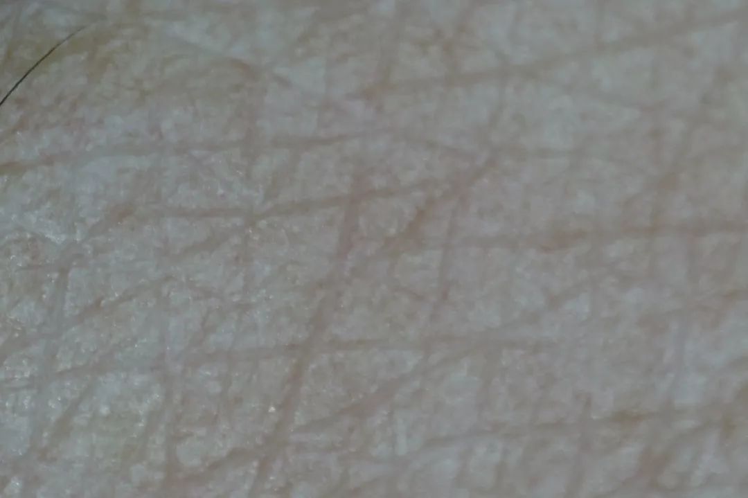 三十岁就有眉间纹法令纹怎么办,30岁法令纹眉心纹深