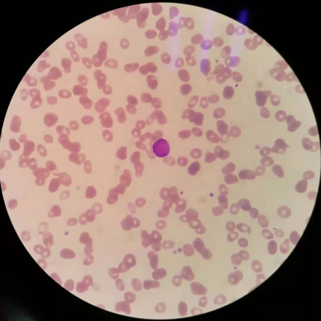 全血细胞减少就是白血病,全血细胞减少性白血病