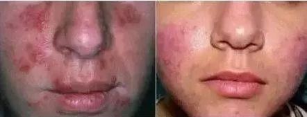 为什么脸上的痘痘那么难消,你脸上的痘痘是螨虫痘吗